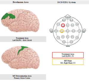 تحریک DLPFC چپ در پروتکل rTMS