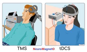 تفاوت های tDCS و rTMS
