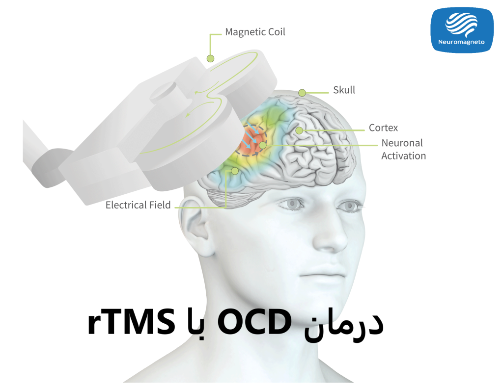 درمان OCD با rTMS